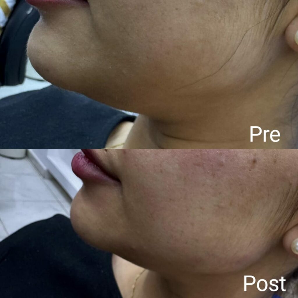 Defining the jaw with fillers